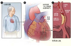 冠心病的起因是什么？
