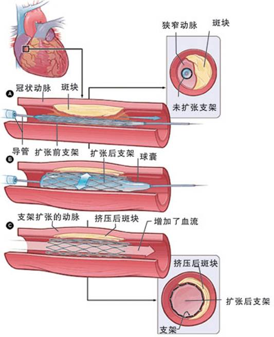 怎樣治療冠心??？(圖2)