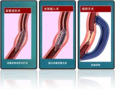 怎樣治療冠心病？