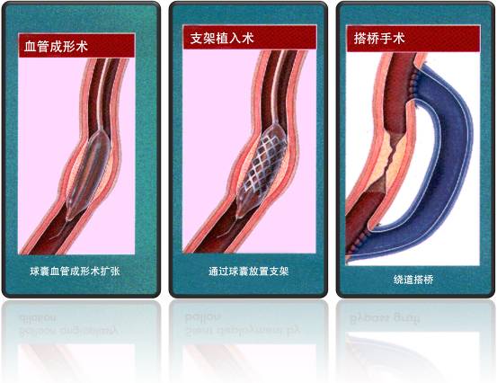 怎樣治療冠心??？(圖1)