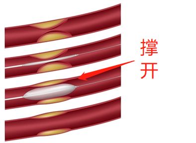 什么是藥物球囊？(圖2)